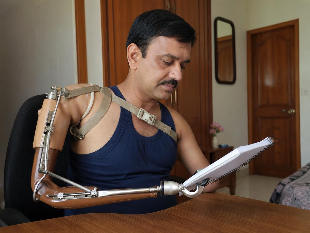 Patient using a body-powered upper limb prosthesis during daily activities